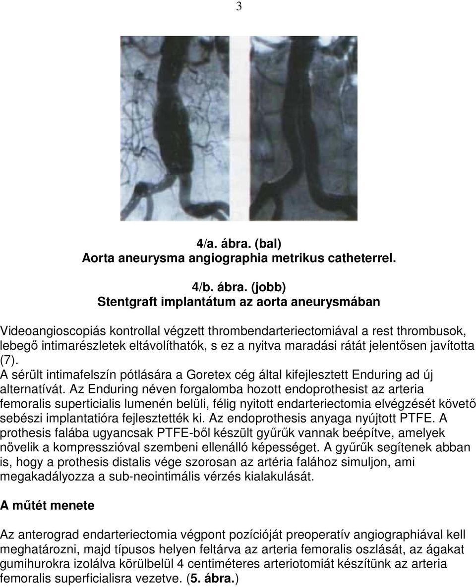 (jobb) Stentgraft implantátum az aorta aneurysmában Videoangioscopiás kontrollal végzett thrombendarteriectomiával a rest thrombusok, lebegı intimarészletek eltávolíthatók, s ez a nyitva maradási