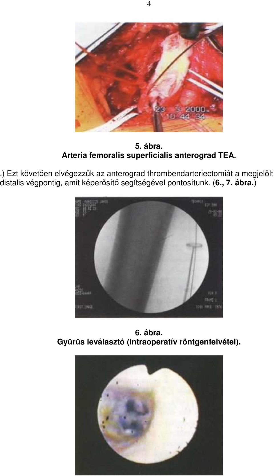 megjelölt distalis végpontig, amit képerısítı segítségével