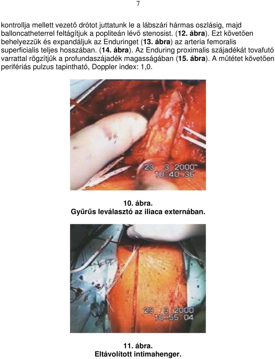 ábra) az arteria femoralis superficialis teljes hosszában. (14. ábra).