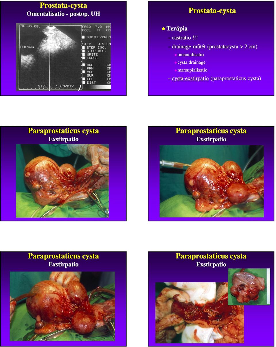 marsupialisatio cystacysta-exstirpatio (paraprostaticus cysta) Paraprostaticus