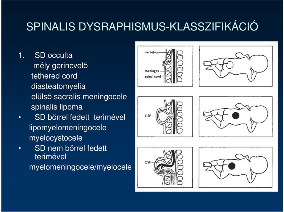 sacralis meningocele spinalis lipoma SD bırrel fedett terimével