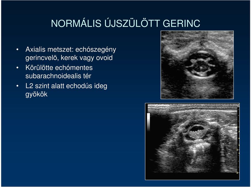 vagy ovoid Körülötte echómentes