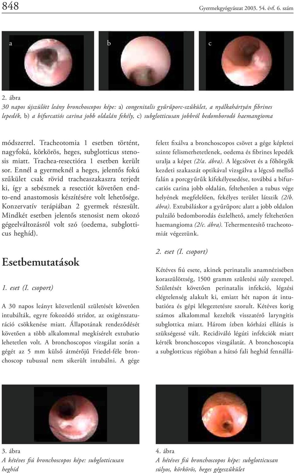 bedomborodó haemangioma módszerrel. Tracheotomia esetben történt, nagyfokú, körkörös, heges, subglotticus stenosis miatt. Trachea-resectióra esetben került sor.