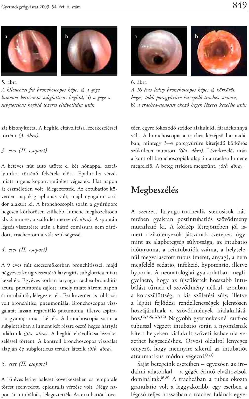 ábra A 6 éves leány bronchoscopos képe: a) körkörös, heges, több porcgyűrűre kiterjedő trachea-stenosis, b) a trachea-stenosist okozó hegek lézeres kezelése után sát bizonyította.