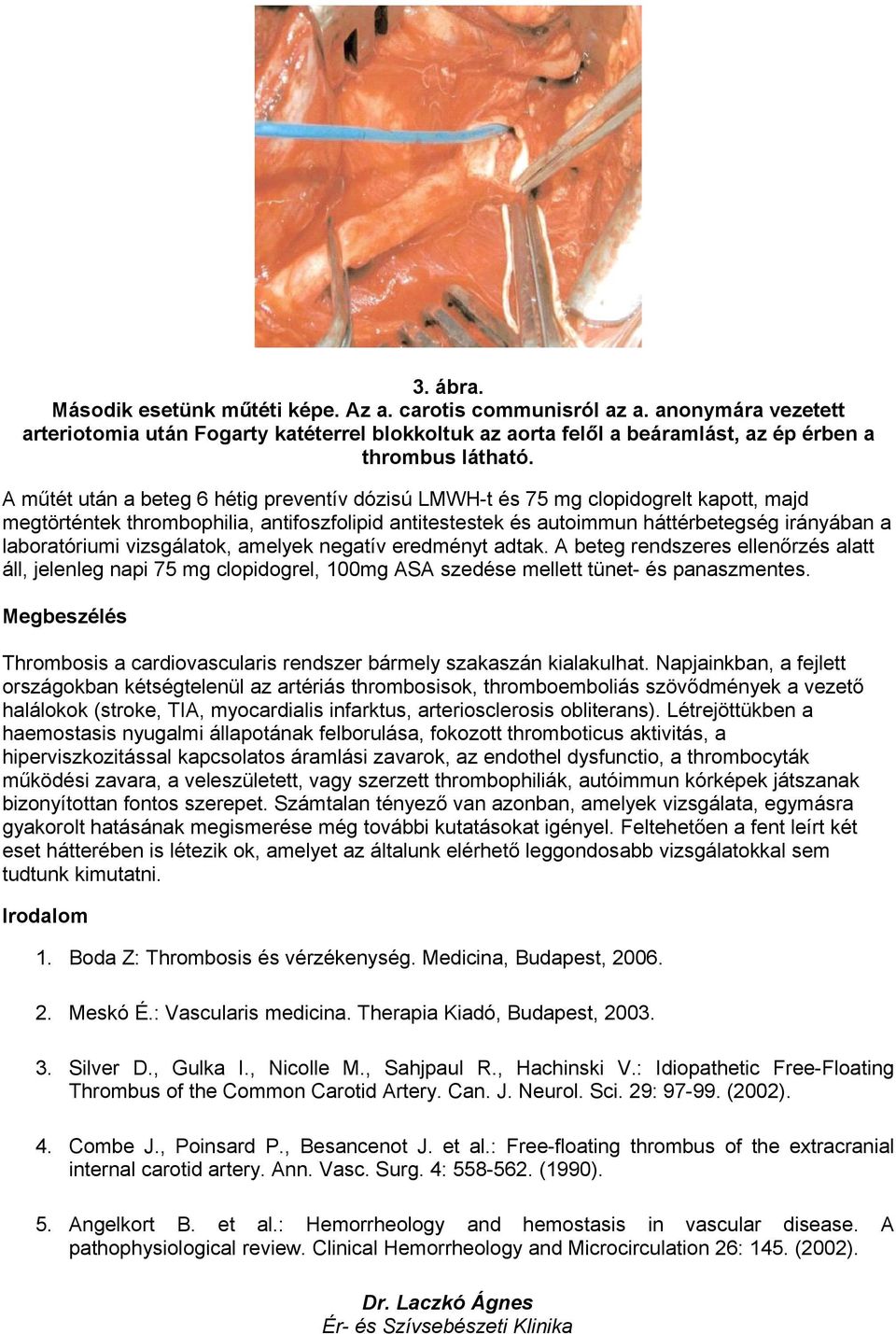 vizsgálatok, amelyek negatív eredményt adtak. A beteg rendszeres ellenőrzés alatt áll, jelenleg napi 75 mg clopidogrel, 100mg ASA szedése mellett tünet- és panaszmentes.