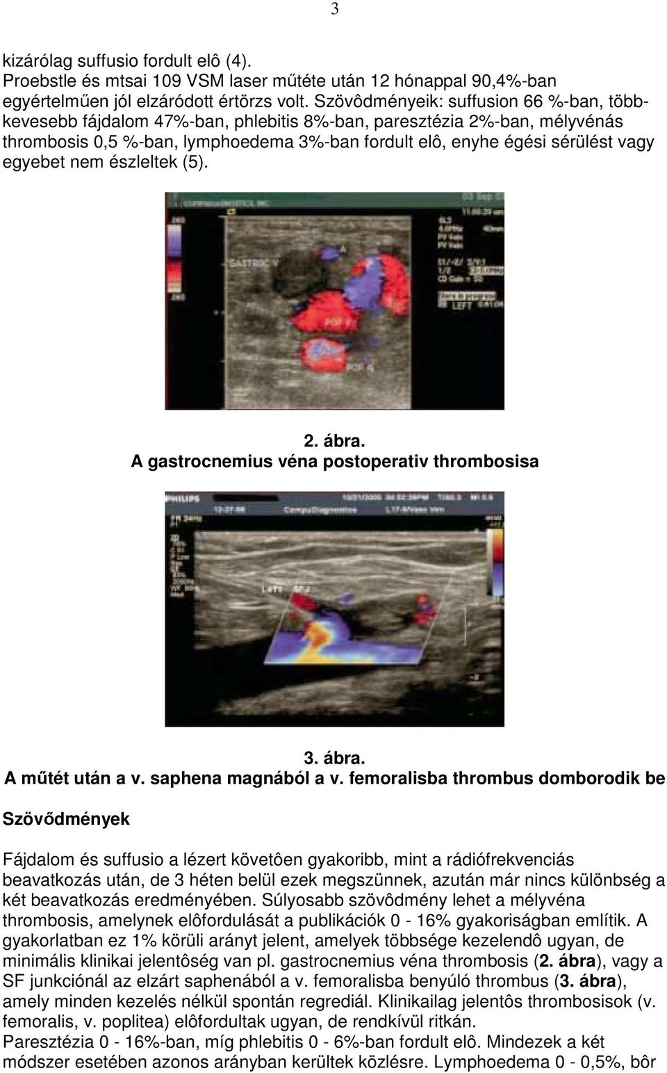 egyebet nem észleltek (5). 2. ábra. A gastrocnemius véna postoperativ thrombosisa 3. ábra. A mőtét után a v. saphena magnából a v.