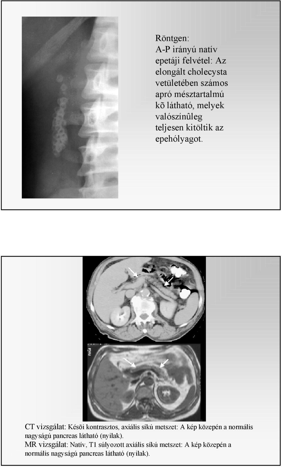 CT vizsgálat: Késõi kontrasztos, axiális síkú metszet: A kép közepén a normális nagyságú pancreas