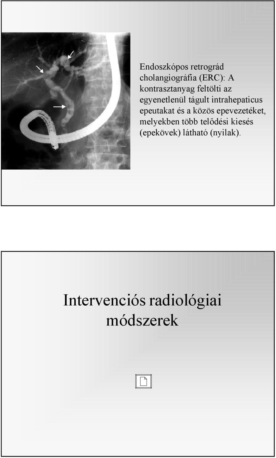 intrahepaticus epeutakat és a közös epevezetéket, melyekben