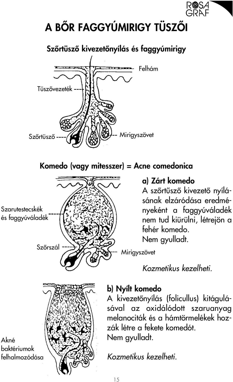 faggyúváladék nem tud kiürülni, létrejön a fehér komedo. Nem gyulladt. Kozmetikus kezelheti.