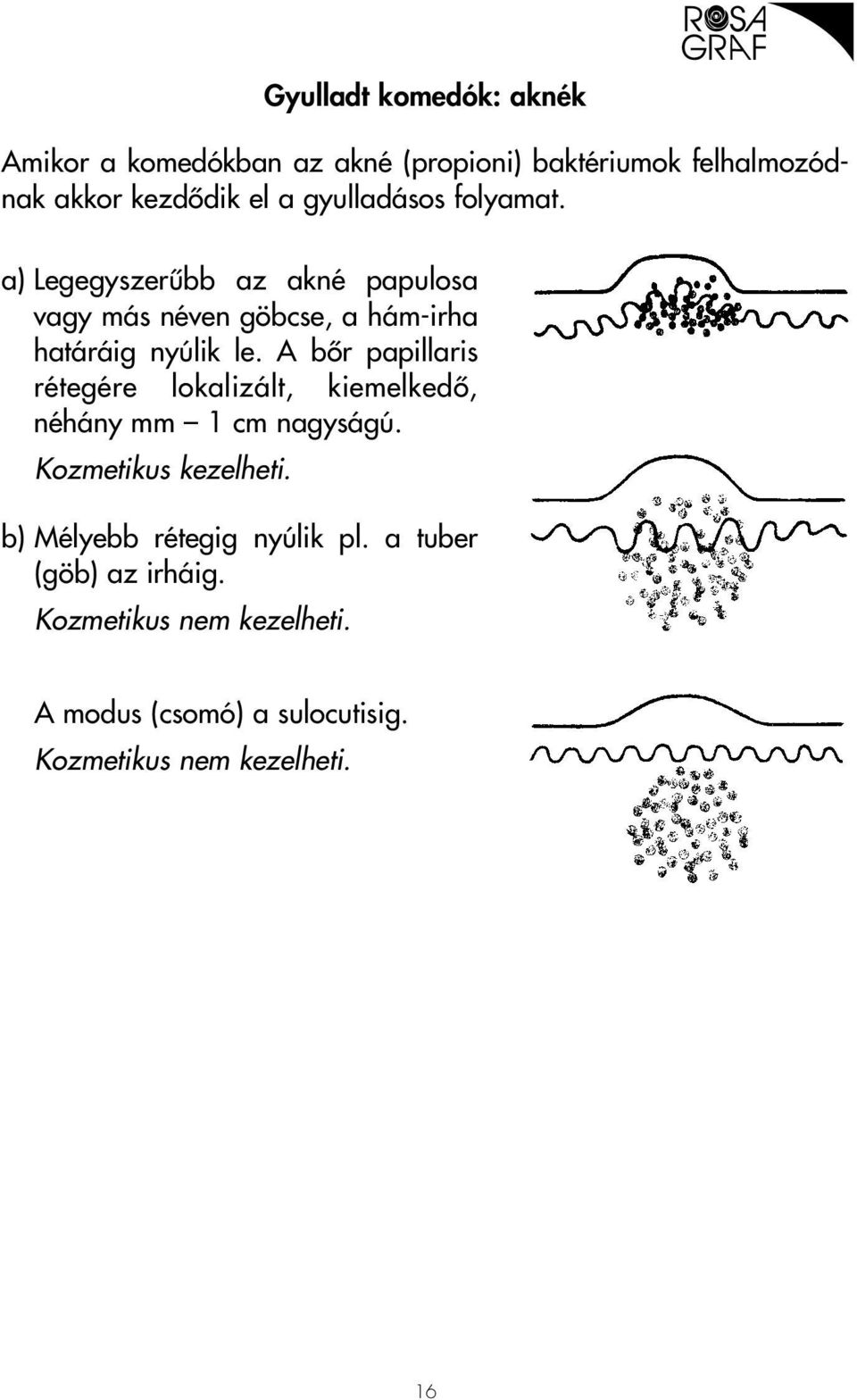 A bôr papillaris rétegére lokalizált, kiemelkedô, néhány mm 1 cm nagyságú. Kozmetikus kezelheti.