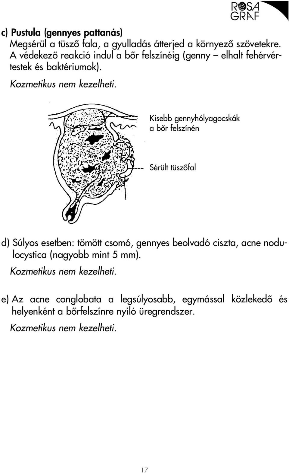 Kisebb gennyhólyagocskák a bôr felszínén Sérült tüszôfal d) Súlyos esetben: tömött csomó, gennyes beolvadó ciszta, acne