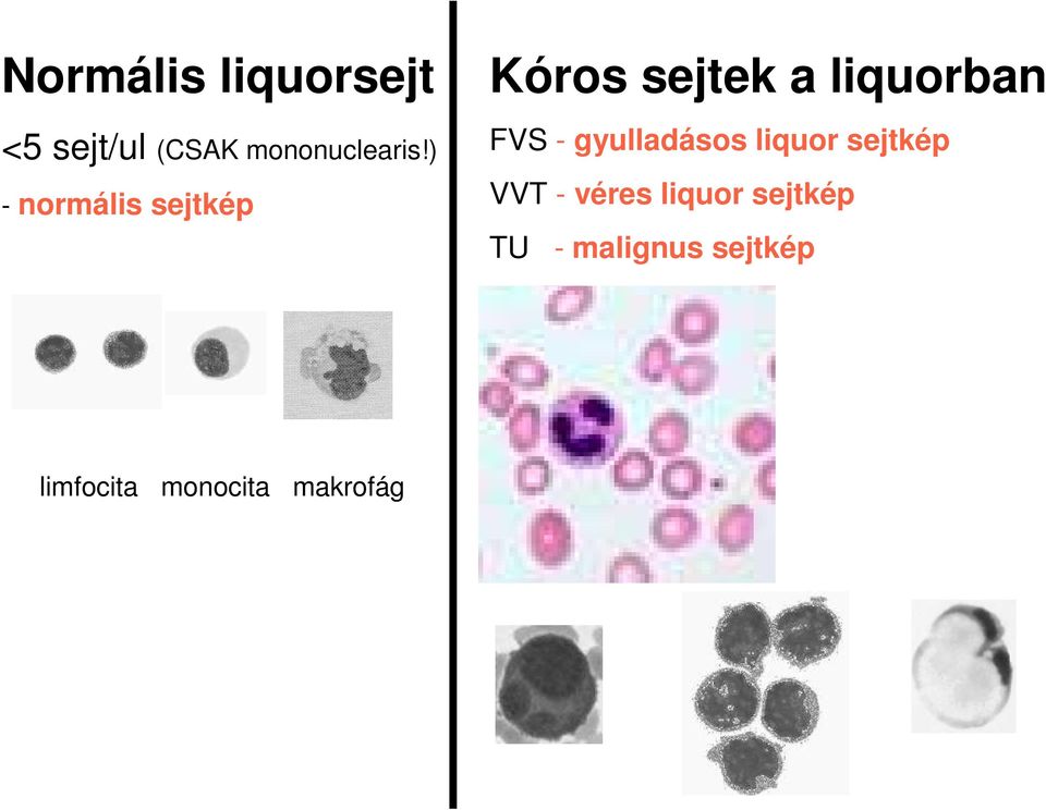 ) normális sejtkép Kóros sejtek a liquorban FVS