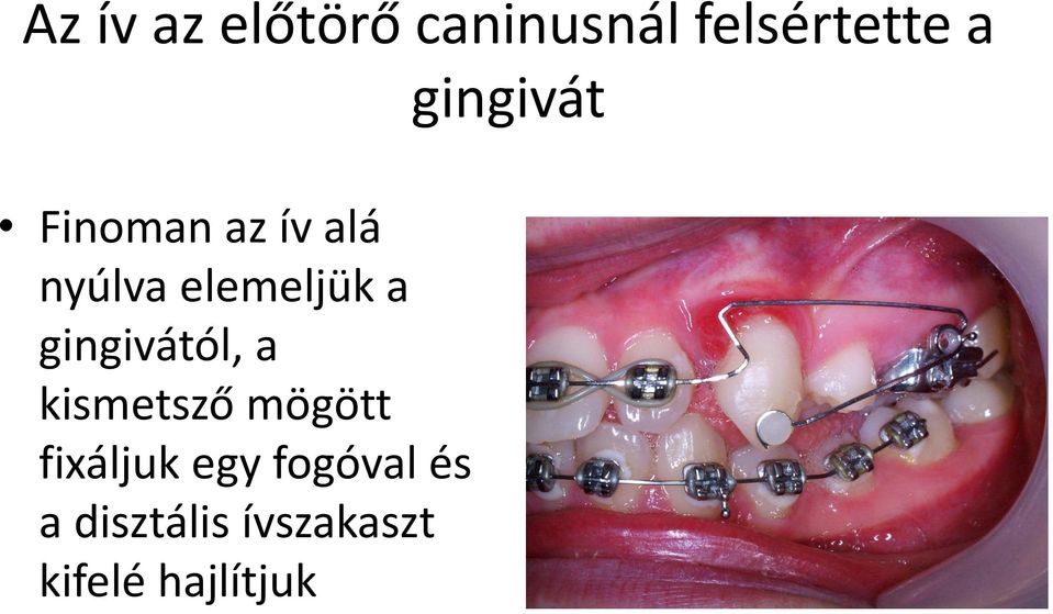 gingivától, a kismetsző mögött fixáljuk egy