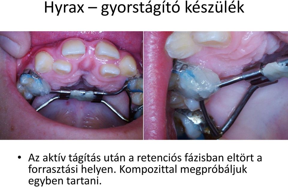 fázisban eltört a forrasztási