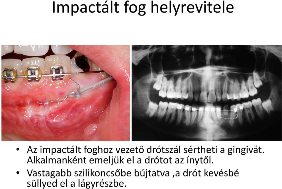 Alkalmanként emeljük el a drótot az ínytől.