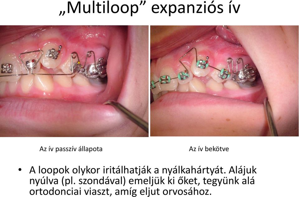 nyálkahártyát. Alájuk nyúlva (pl.