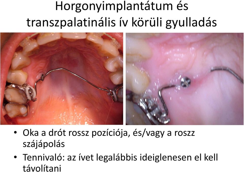 pozíciója, és/vagy a roszz szájápolás