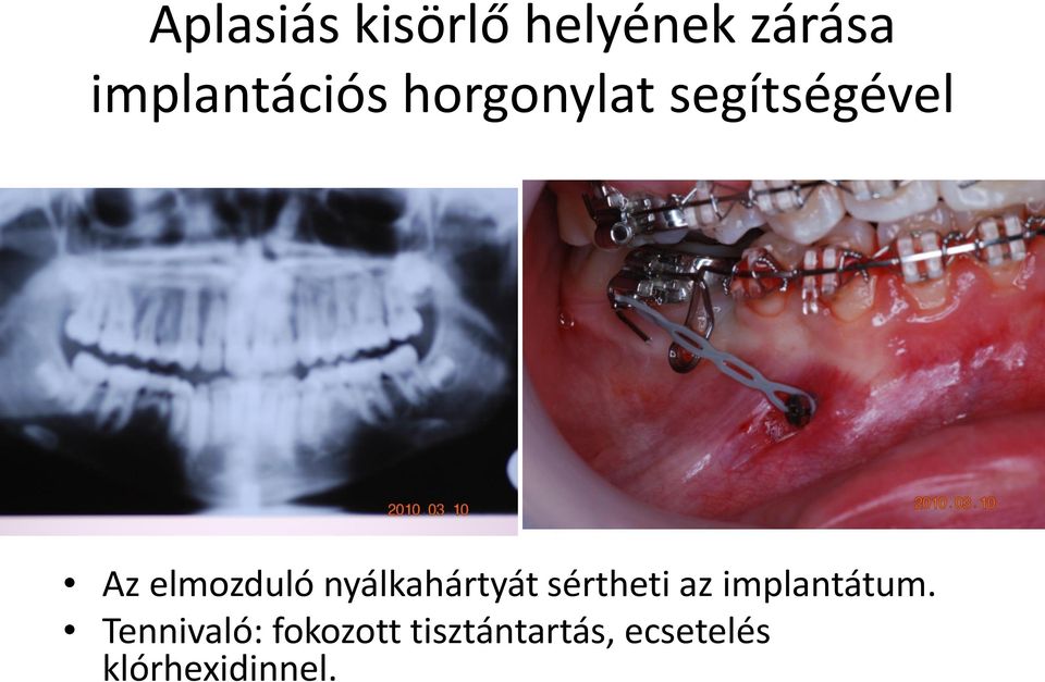 nyálkahártyát sértheti az implantátum.