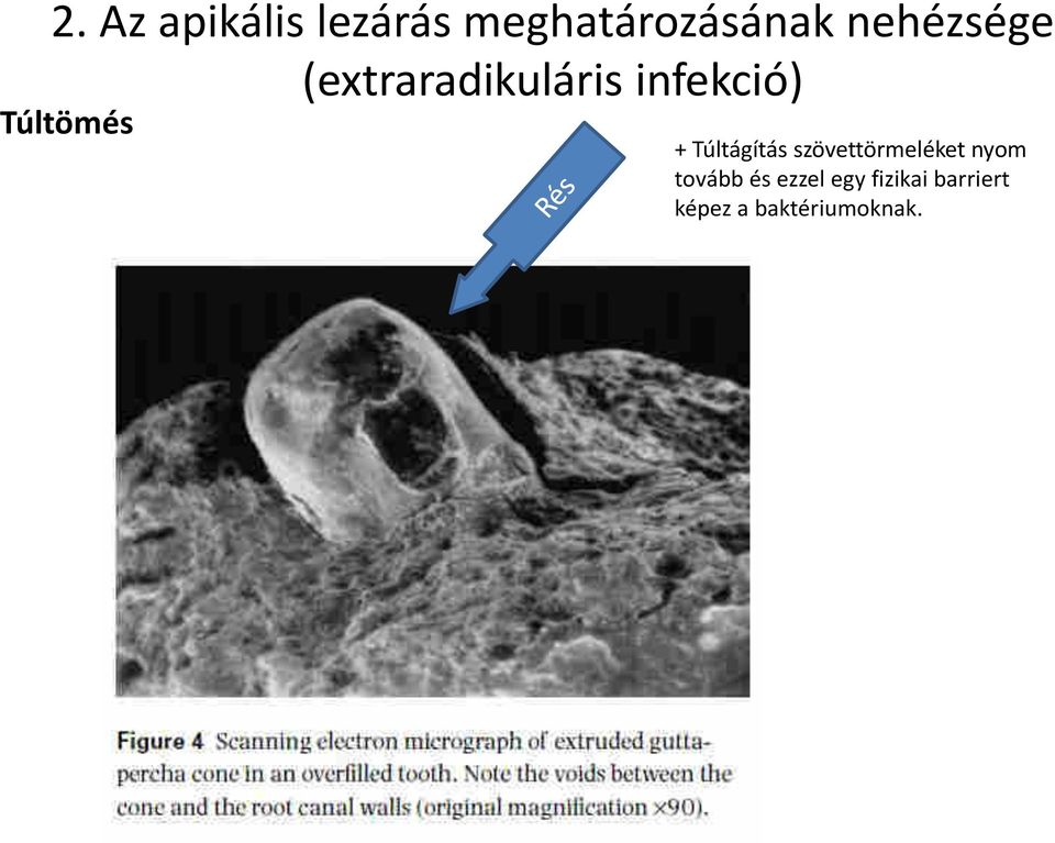 Túltömés + Túltágítás szövettörmeléket nyom