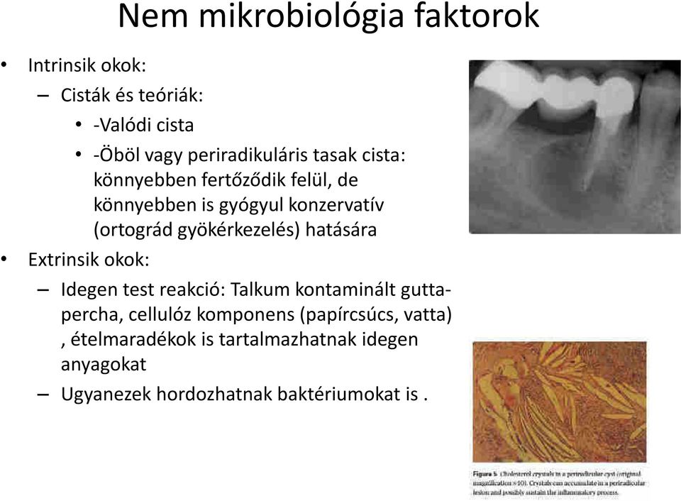 hatására Extrinsik okok: Idegen test reakció: Talkum kontaminált guttapercha, cellulóz komponens