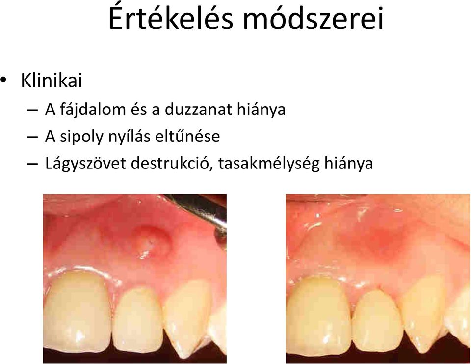 sipoly yílás eltű ése