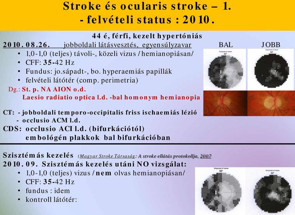 perimetria) Dg.: St. p. NA AION o.d. Laesio radiatio optica l.d. -bal homonym hemianopia CT: - jobboldali temporo-occipitalis friss ischaemiás lézió - occlusio ACM l.d. CDS: occlusio ACI l.