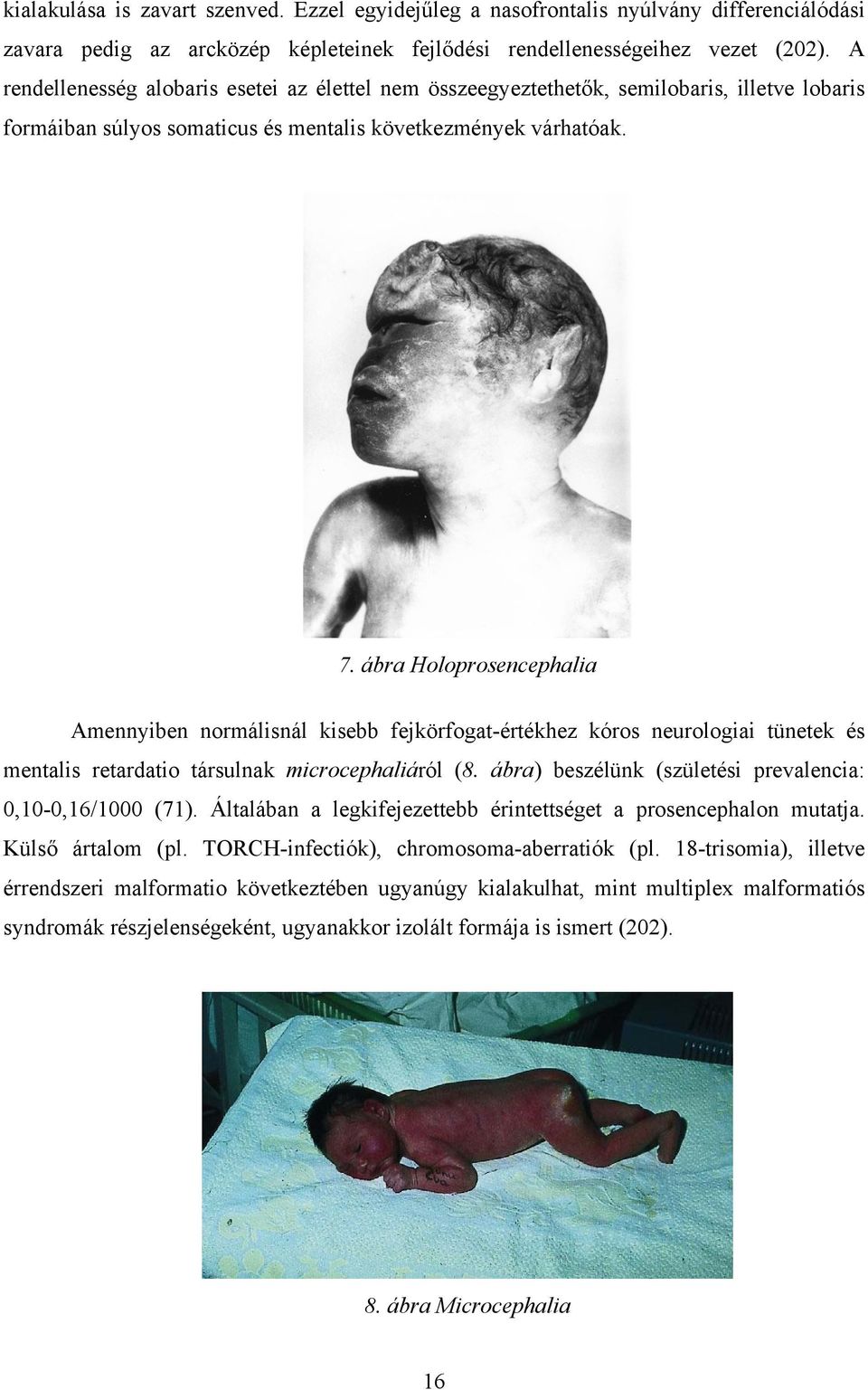 ábra Holoprosencephalia Amennyiben normálisnál kisebb fejkörfogat-értékhez kóros neurologiai tünetek és mentalis retardatio társulnak microcephaliáról (8.