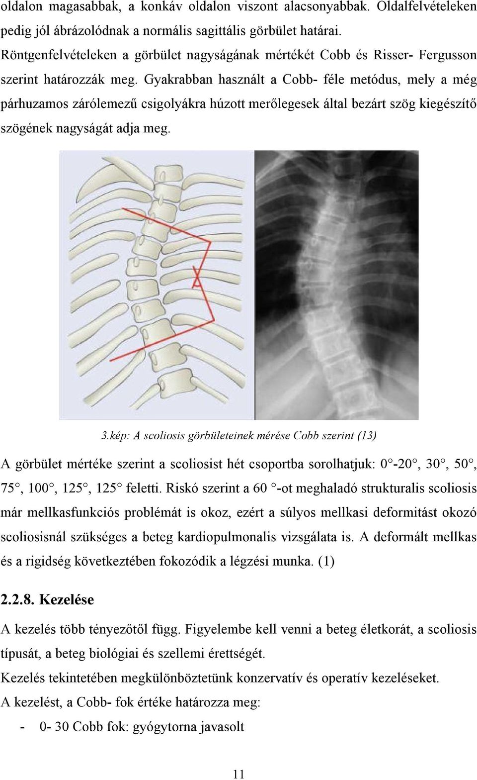 Gyakrabban használt a Cobb- féle metódus, mely a még párhuzamos zárólemezű csigolyákra húzott merőlegesek által bezárt szög kiegészítő szögének nagyságát adja meg. 3.