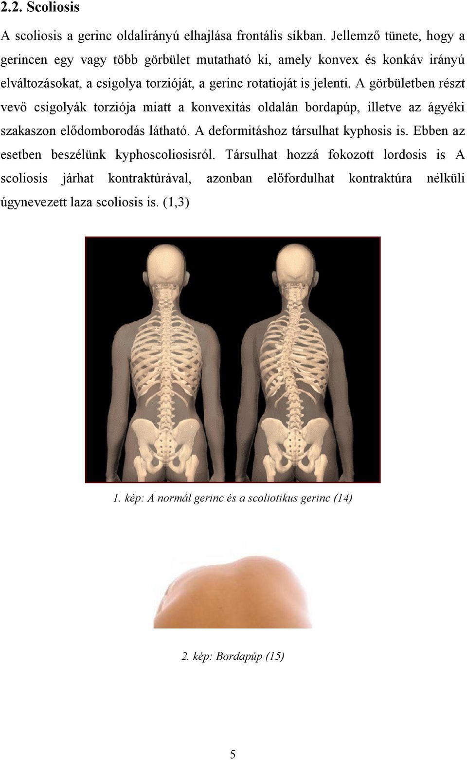 A görbületben részt vevő csigolyák torziója miatt a konvexitás oldalán bordapúp, illetve az ágyéki szakaszon elődomborodás látható. A deformitáshoz társulhat kyphosis is.