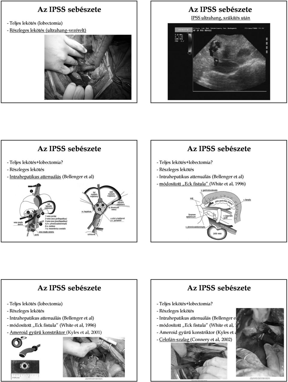 - Részleges lekötés - Intrahepatikus attenuálás (Bellenger et al) - módosított Eck fistula (White et al, 1996) - Teljes lekötés (lobectomia) - Részleges lekötés - Intrahepatikus