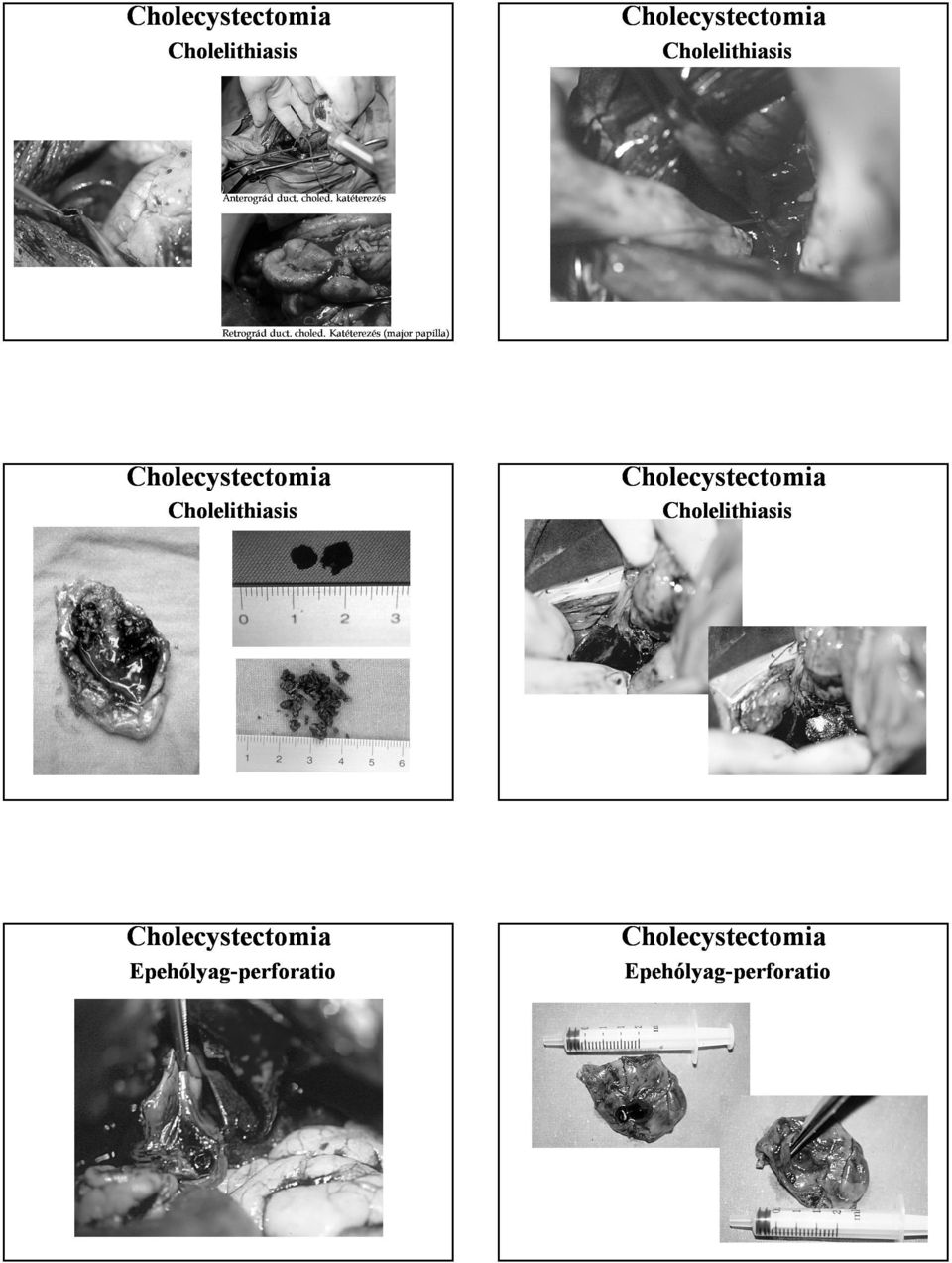 Katéterezés (major papilla) Cholelithiasis