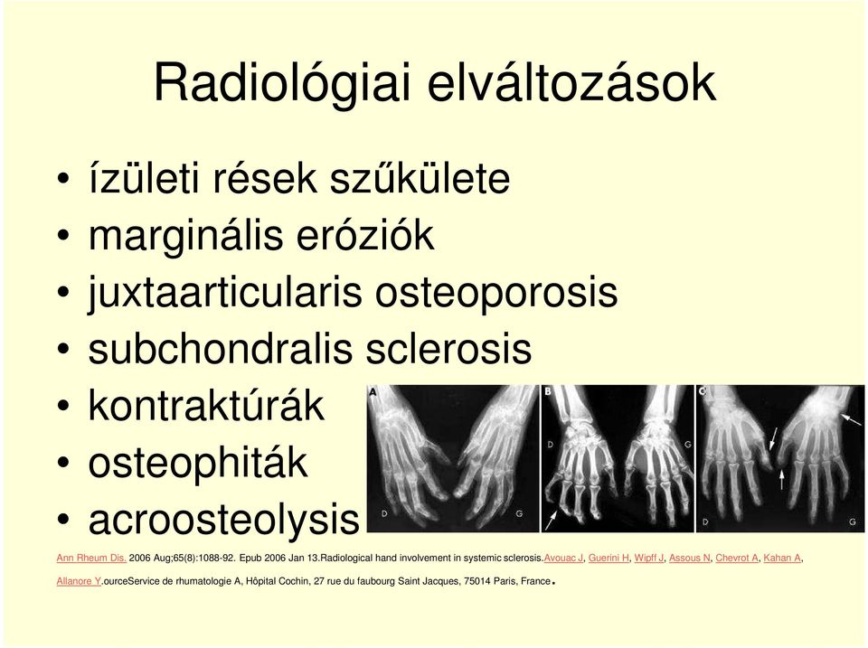 Epub 2006 Jan 13.Radiological hand involvement in systemic sclerosis.