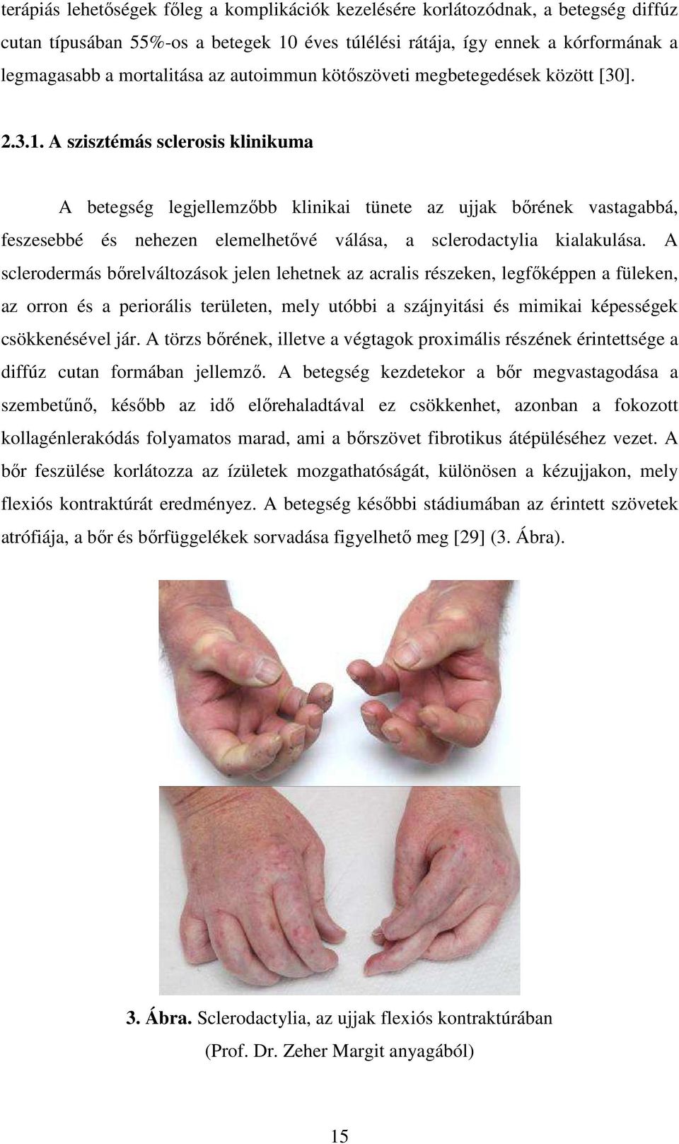 A szisztémás sclerosis klinikuma A betegség legjellemzőbb klinikai tünete az ujjak bőrének vastagabbá, feszesebbé és nehezen elemelhetővé válása, a sclerodactylia kialakulása.