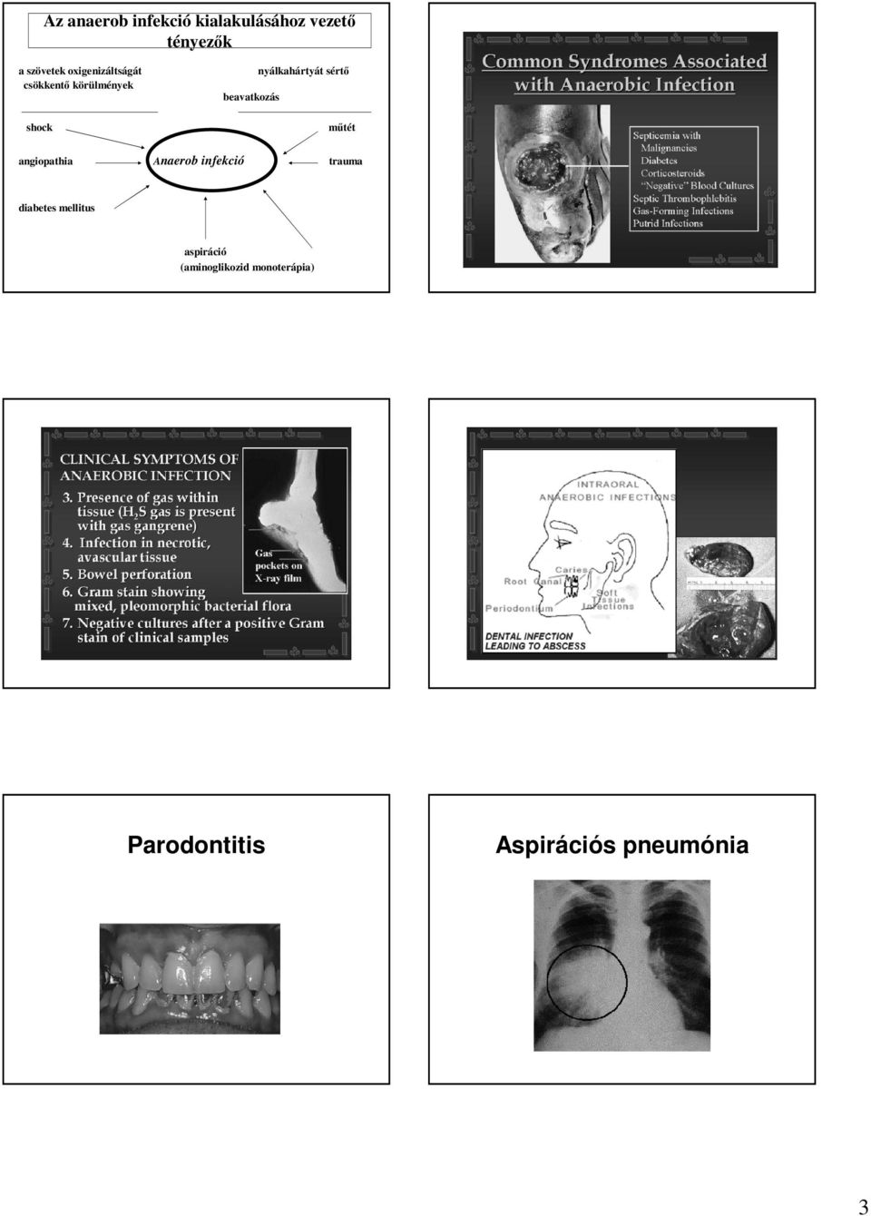 nyálkahártyát sértő műtét angiopathia Anaerob infekció trauma