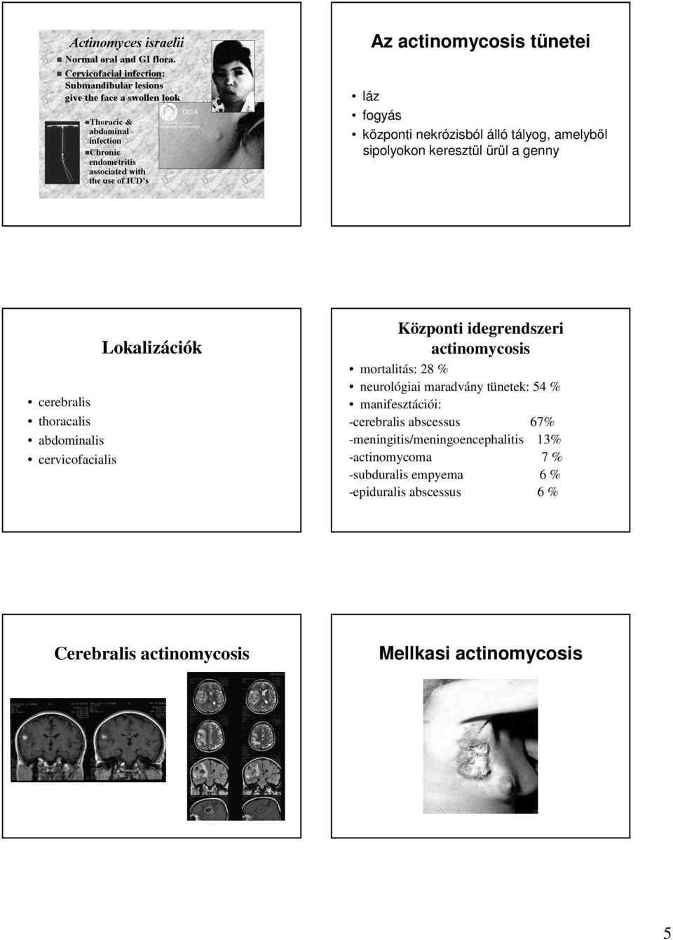 % neurológiai maradvány tünetek: 54 % manifesztációi: -cerebralis abscessus 67% -meningitis/meningoencephalitis 13%