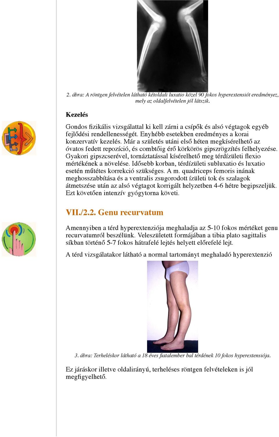 A térdízület patellofemoralis arthrosisza - Homorú-domború lencse