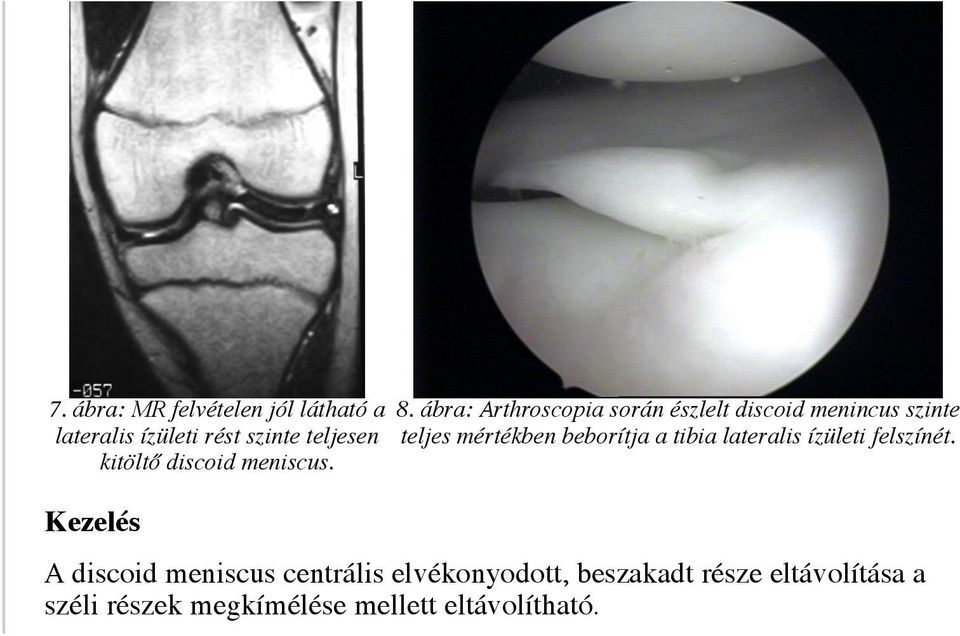 teljesen teljes mértékben beborítja a tibia lateralis ízületi felszínét.
