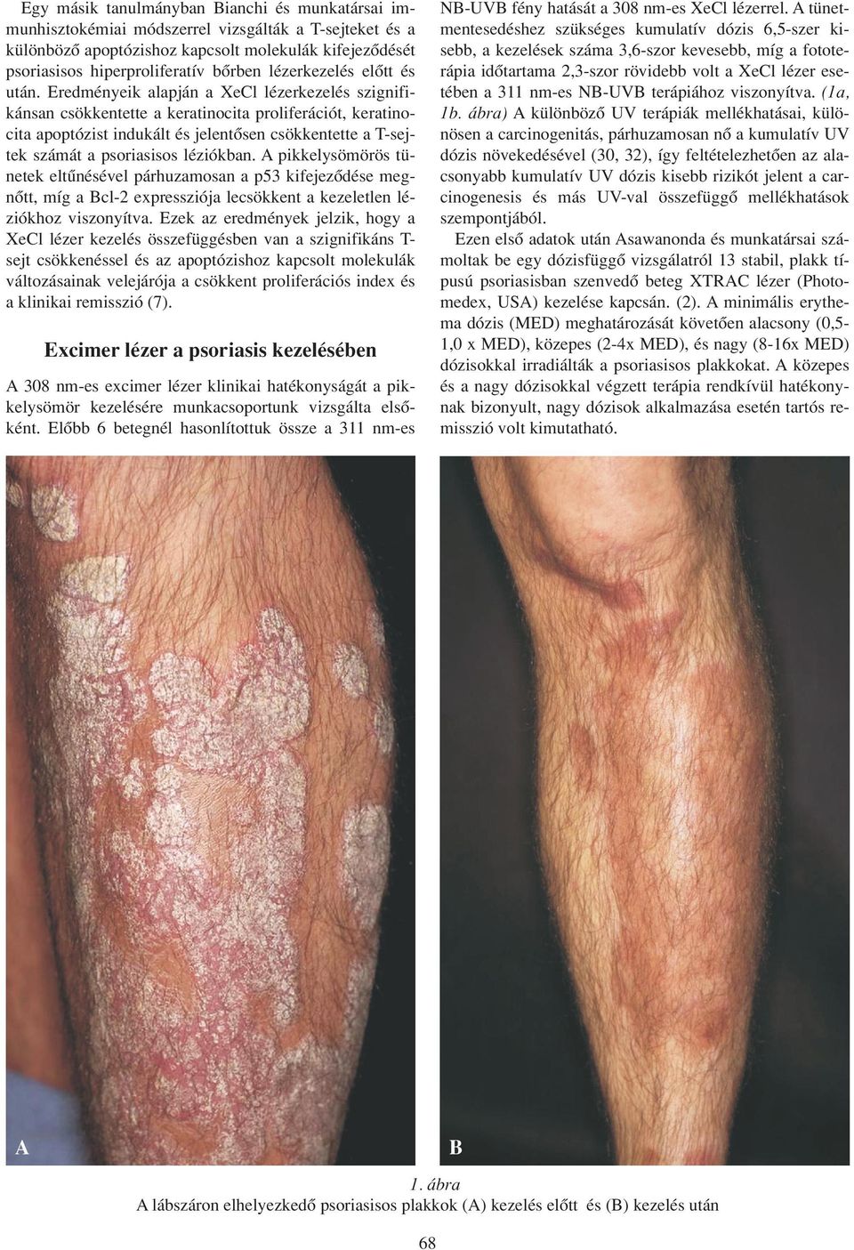 xenon pikkelysömör kezelése a bőrt vörös foltok borítják, mint fürdés után