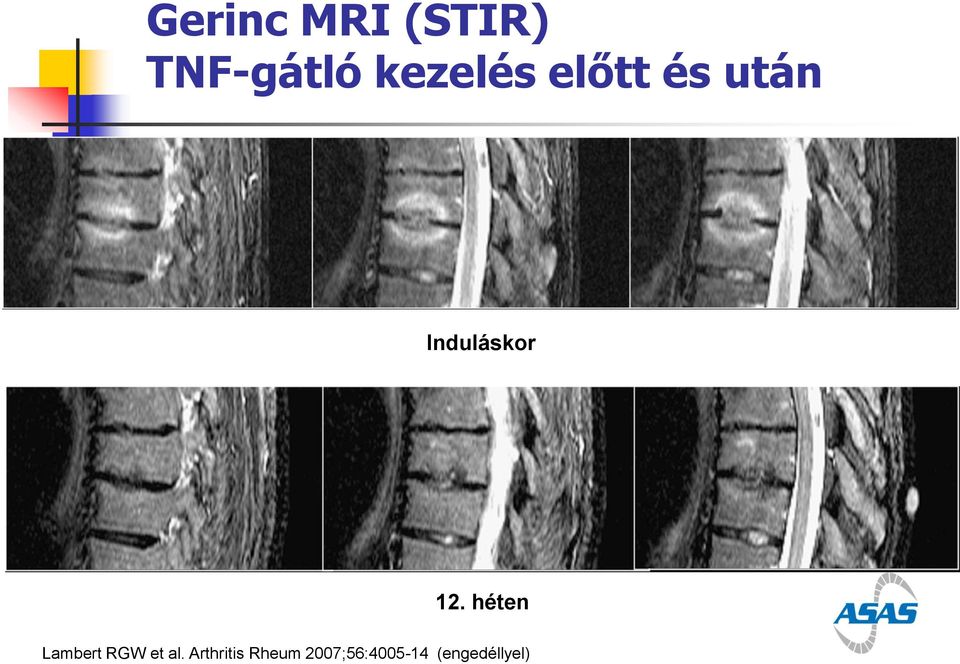 (engedéllyel) Gerinc MRI (STIR)