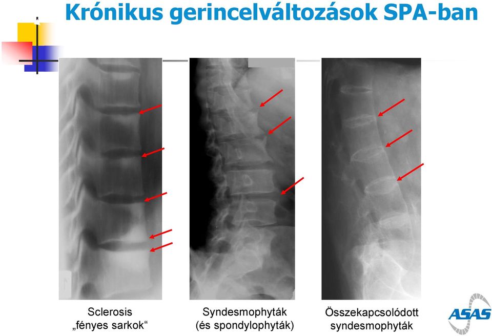 Syndesmophyták (és