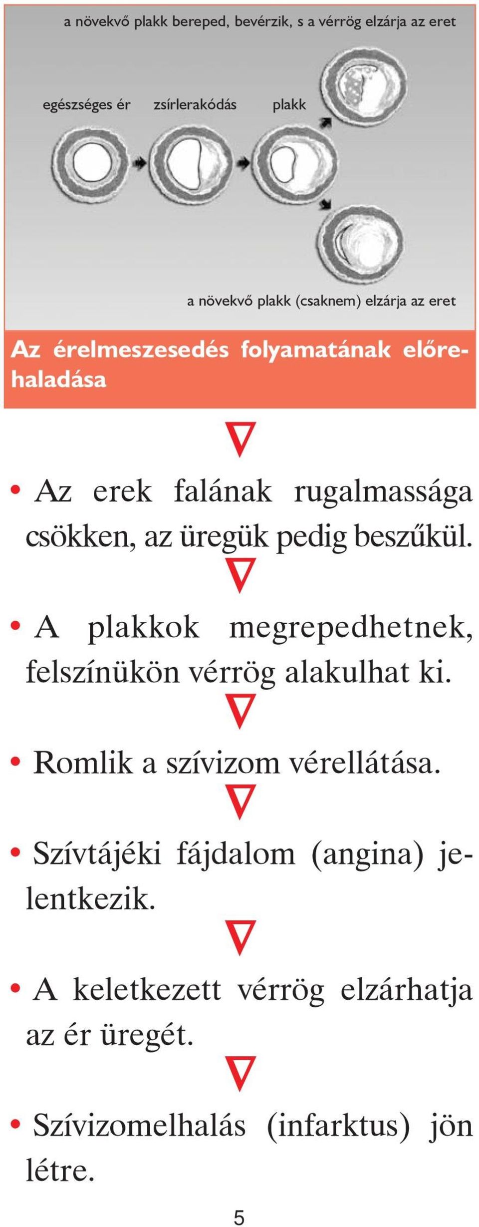 üregük pedig beszûkül. A plakkok megrepedhetnek, felszínükön vérrög alakulhat ki. Romlik a szívizom vérellátása.