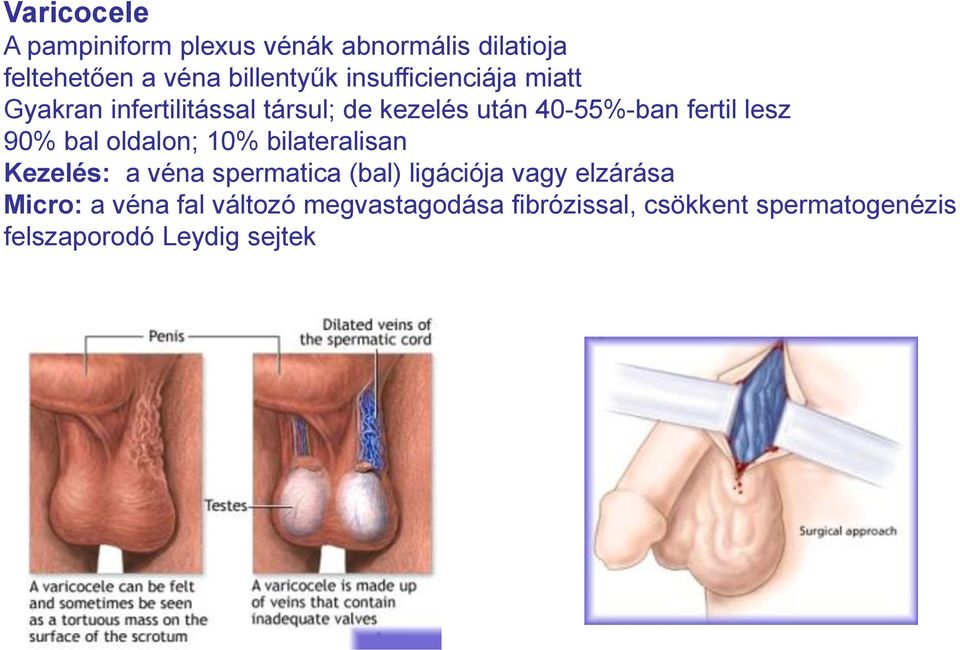 90% bal oldalon; 10% bilateralisan Kezelés: a véna spermatica (bal) ligációja vagy elzárása