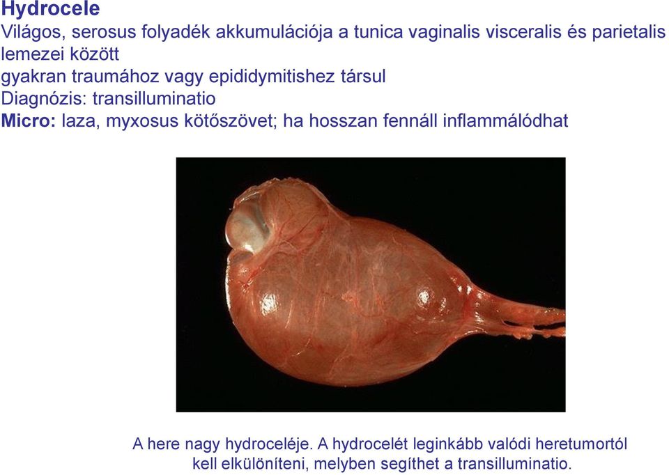 Micro: laza, myxosus kötőszövet; ha hosszan fennáll inflammálódhat A here nagy hydroceléje.