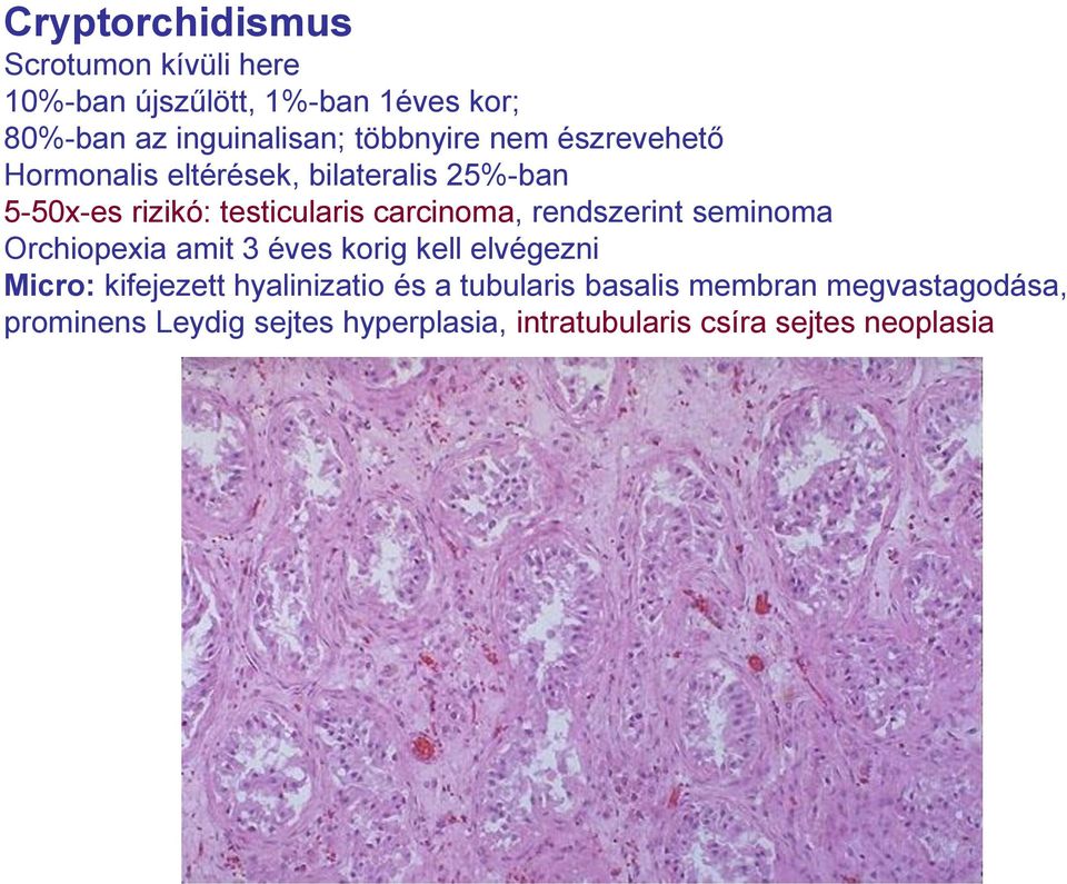 carcinoma, rendszerint seminoma Orchiopexia amit 3 éves korig kell elvégezni Micro: kifejezett