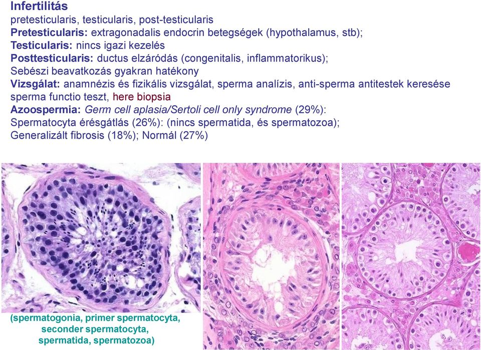 analízis, anti-sperma antitestek keresése sperma functio teszt, here biopsia Azoospermia: Germ cell aplasia/sertoli cell only syndrome (29%): Spermatocyta érésgátlás