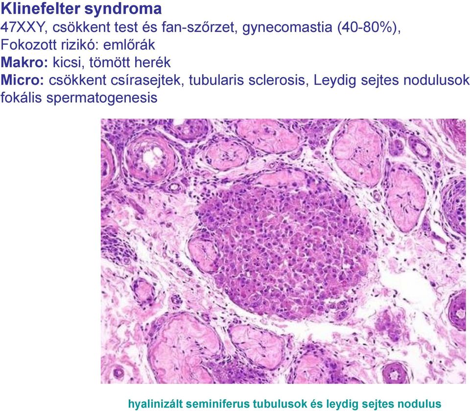 csökkent csírasejtek, tubularis sclerosis, Leydig sejtes nodulusok