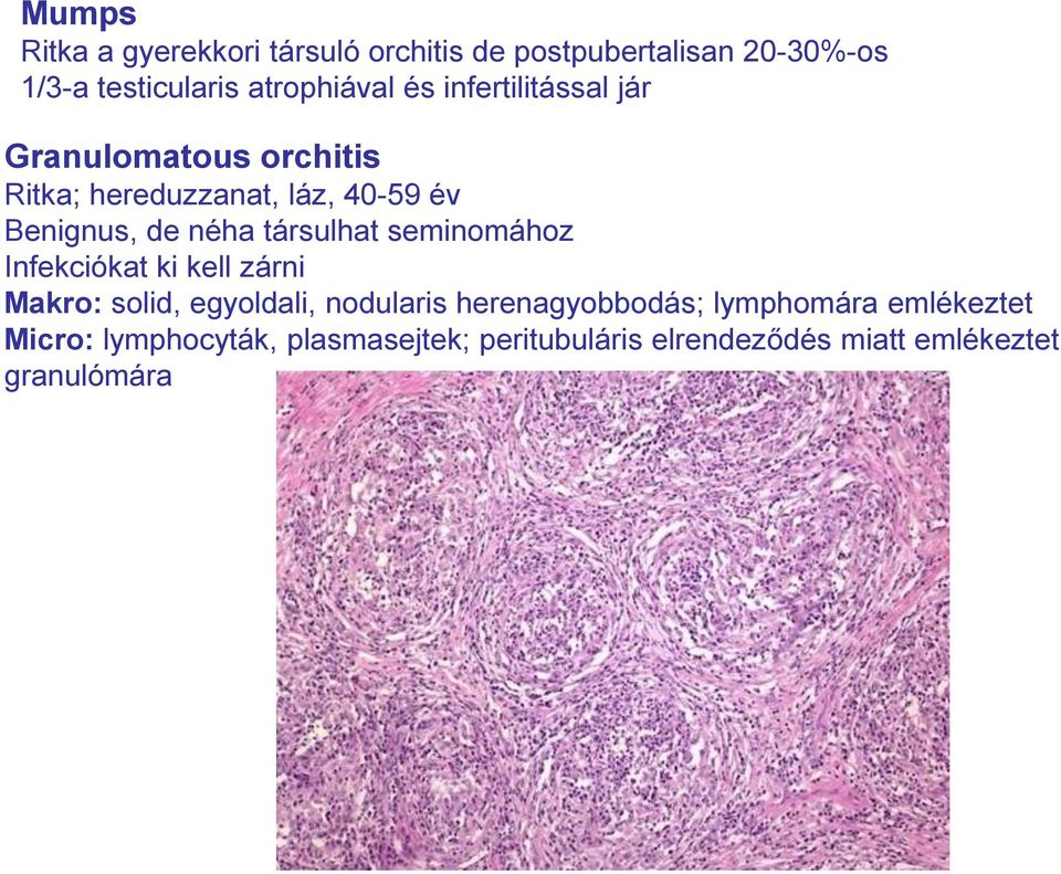 társulhat seminomához Infekciókat ki kell zárni Makro: solid, egyoldali, nodularis herenagyobbodás;