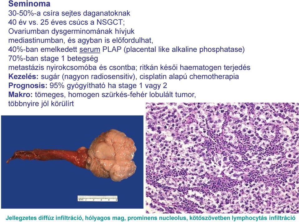 alkaline phosphatase) 70%-ban stage 1 betegség metastázis nyirokcsomóba és csontba; ritkán késői haematogen terjedés Kezelés: sugár (nagyon