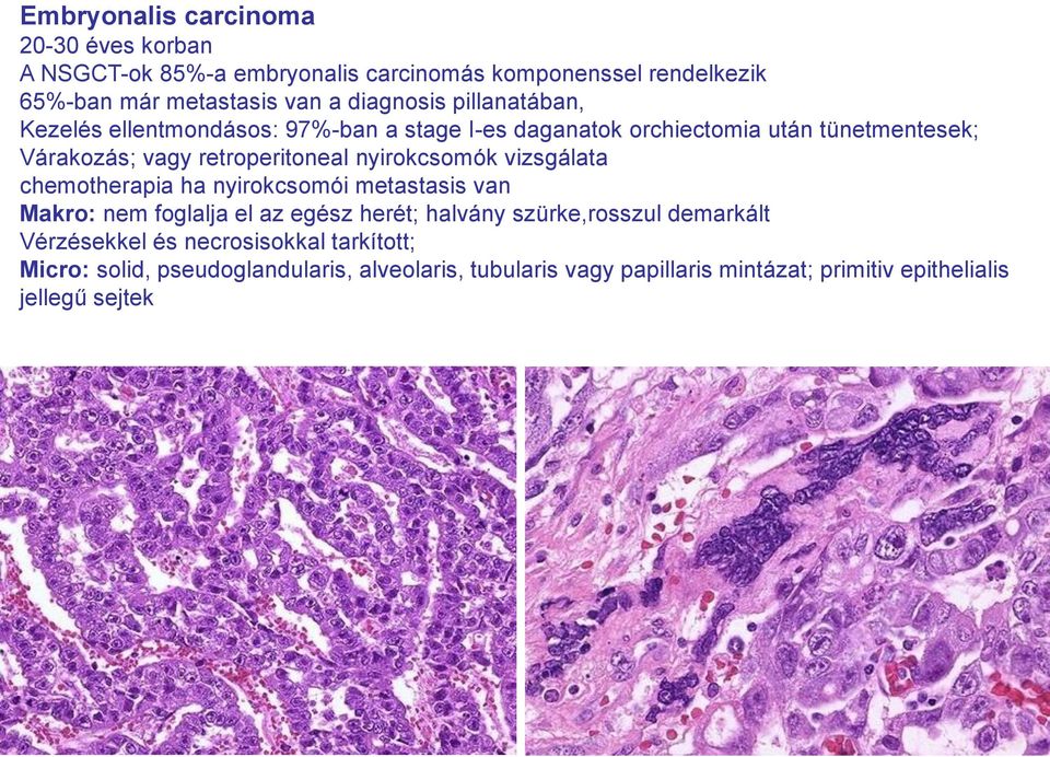 nyirokcsomók vizsgálata chemotherapia ha nyirokcsomói metastasis van Makro: nem foglalja el az egész herét; halvány szürke,rosszul demarkált