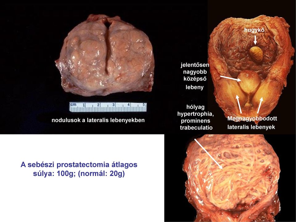 trabeculatio Megnagyobbodott lateralis lebenyek A